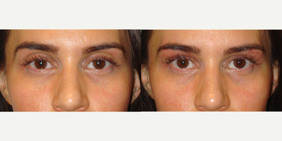 28 year old woman treated with Belotero filler injection in the upper eyelids-brows - 26 year old female, with underwent Belotero filler injection in the upper eyelids and brows.