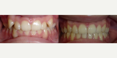 Woman treated with Braces - Halloween got you thinkin maybe I dont need my fang teeth anymore ... thats what our patient thought too.