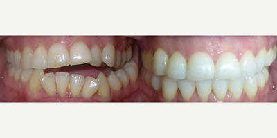 Woman treated with Braces - asymmetric openbite braces+orthognathicsurgerythe impossible is possible