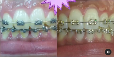 17 or under year old man treated with Braces - 17 or under year old man treated with Braces