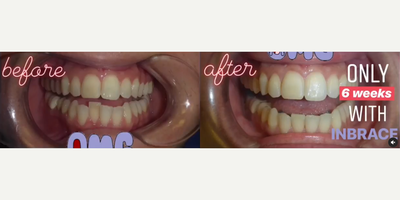 Woman treated with Braces - Our patients progress so far! These results are after only 6 weeks with my InBrace.