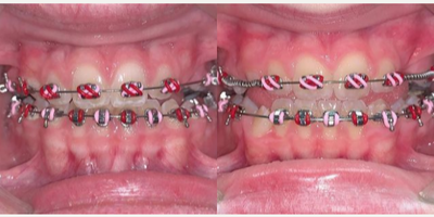17 or under year old woman treated with Braces - 17 or under year old woman treated with Braces