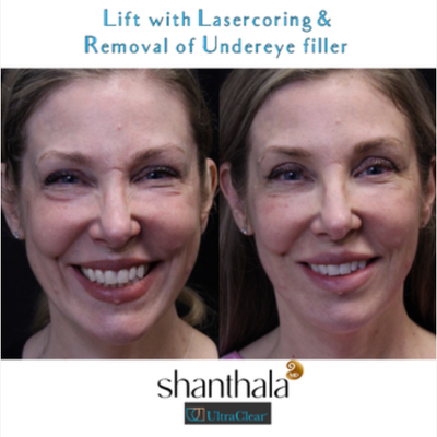 Patient treated with UltraClear Laser - Patient treated with UltraClear Laser