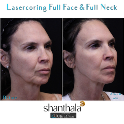 Patient treated with UltraClear Laser - Patient treated with UltraClear Laser