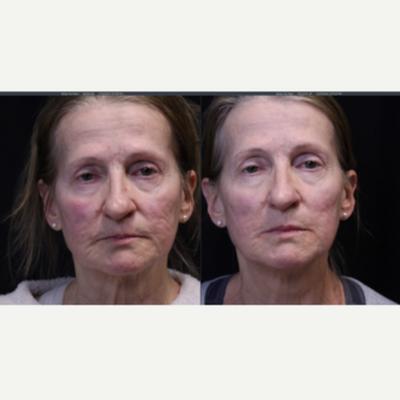 Woman treated with UltraClear Laser - Woman treated with UltraClear Laser