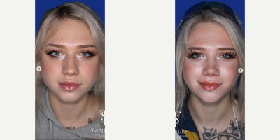 Woman treated with Rhinoplasty - Beautiful results 3 months after a finesse Rhinoplasty. This patient didnt like her previously boxy tip and wanted a smaller, more refined nose but didnt need major changes.I did an open Rhinoplasty, supported and refined her nasal tip giving her the feminine profile shes always wanted. She loves her new nose and so do we!