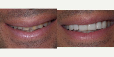 We brightened and enhanced his smile with six veneers. - Patient had small teeth that had considerable ware. We brightened and enhanced his smile with six veneers.