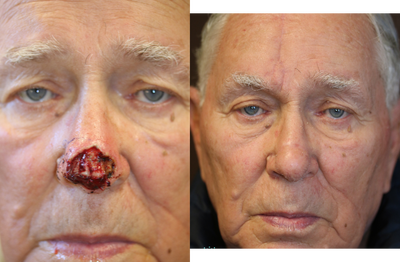 Mohs surgery and reconstruction to tip of nose - Basal cell carcinoma treated with Mohs surgery and a paramedian forehead flap reconstruction.