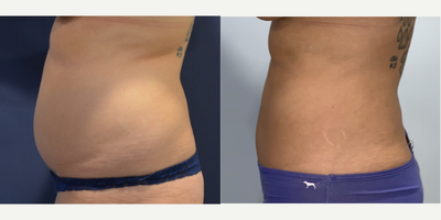 25-34 year old woman treated with Liposuction - This is an active young woman who exhausted her ability to achieve her goals through diet & exercise. She finally tried liposuction of her abdomen & flanks.
