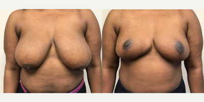 25-34 year old woman treated with Breast Reduction - 33 year old female shown before and 4 months after a bilateral breast reduction using an anchor incision. The patient is 56 tall and weighs 180 pounds. She was a G cup prior and is now a C cup. The patient effectively used a supportive surgical bra and scar cream for 3 monthst afterward. All procedures done by Frank J. Ferraro, MD&nbsp;