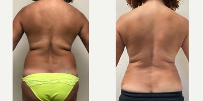35-44 year old woman treated with i-Lipo - Surgeon: Dr. AlexanderProcedure: Lipo 360