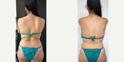 35-44 year old woman treated with Lipodissolve - One mont after cryolipolysis treatment