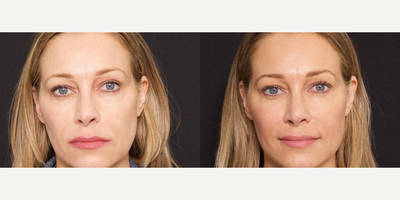 Woman treated with Bellafill - The wait is over. Check out these gorgeous BellaPlasma Lift results! This revolutionary anti-aging facial treatment utilizes the most advanced regenerative cell therapy products to give you a naturally beautiful transformation tailored to YOUR SPECIFIC NEEDS.This proprietary combination procedure utilizes biostimulatory product working synergistically with Platelet Rich Plasma (PRP), to naturally rebuild your own collagen that has been lost to aging, in addition to instantly lifting loose, sagging tissues with Threads.