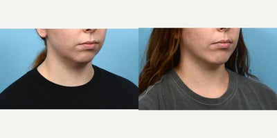 25-34 year old woman treated with Chin Surgery - This 27-year-old patient wanted to subtly enhance the projection of her weak chin, and smooth out her front jawline. Two months after her chin implant surgery, she's happy with the natural and defined appearance Dr. Wise was able to provide her.
