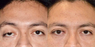 25-34 year old man treated with Eyelid Surgery, Ptosis Surgery - Male patient treated with Eyelid Surgery  and Ptosis Surgery.