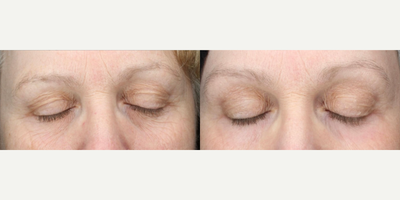 Woman treated with Scar Removal, Laser Scar Removal - Woman treated with Laser Resurfacing.