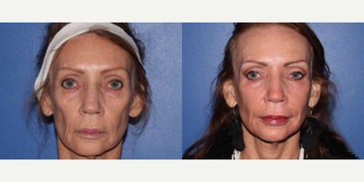 55-64 year old woman treated with Scar Removal, Laser Scar Removal - This patient had full face ProFractional done.