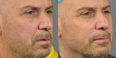 Man treated with Voluma, Juvederm - Voluma to cheeks, Juvederm to folds