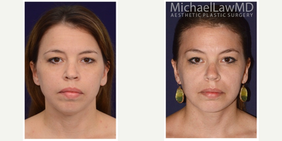 25-34 year old woman treated with Chin Surgery - 34 years - Structural fat grafting of bilateral peri-orbital area, anterior cheeks, chin; syringe fat aspiration of supra-nasolabial fold area, lower lateral cheeks; hairline stabilizing, subcutaneous brow lift; submandibular liposuction; subplatysmal lipectomy and platysmaplasty; Alloplastic chin augmentation
