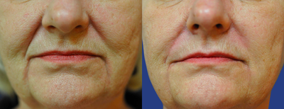 Volumizing Filler to Smile Lines and Marionette Lines - 	Perlane adds volume to fill creases by the nose and mouth that contribute to the appearance of aging