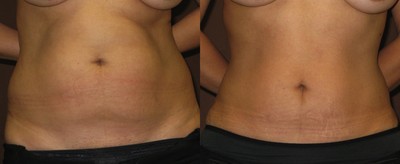 36 year old female with abdominal fat excess - 36 year old with mild skin laxity and excess abdominal fat.  She underwent a mini tummy tuck with liposuction of the abdomen.