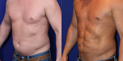 35-44 year old man treated with Gynecomastia Surgery - Gynecomastia/ Liposuction/Renuvion Skin tightening