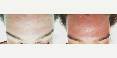 45-54 year old woman treated with Pelleve - Pelleve Wrinkle Reduction System is a safe and effective non-surgical facelift