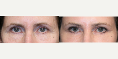 Enigmalift Upper and Lower Eyelid Surgery - Enigmalift - Browlift with upper and lower eyelid surgery with laser resurfacing.