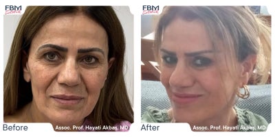 45-54 year old woman treated with Deep Plane Facelift, Eyelid Surgery, Facial Fat Transfer - 45-54 year old woman treated with Deep Plane Facelift, Eyelid Surgery, Facial Fat Transfer