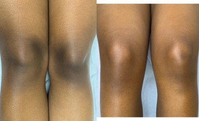 25-34 year old woman treated with Skin Lightening - Before and after.