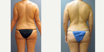 Liposuction Results for this 40-year-old Woman - Tummy Tuck, Breast Implant Removal, Capsulectomy, Liposuction (Flanks) and Fat Transfer (Thigh) for this 40-year-old woman
