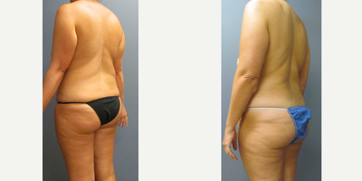 Liposuction Results for this 40-year-old Woman - Tummy Tuck, Breast Implant Removal, Capsulectomy, Liposuction (Flanks) and Fat Transfer (Thigh) for this 40-year-old woman