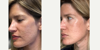 24-34 year old woman treated with TotalFX - 24-34 year old woman treated with TotalFX