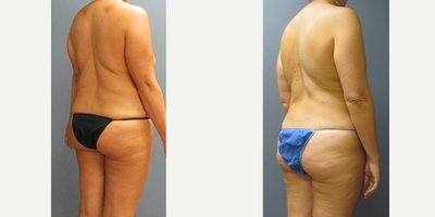 Liposuction Results for this 40-year-old Woman - Tummy Tuck, Breast Implant Removal, Capsulectomy, Liposuction (Flanks) and Fat Transfer (Thigh) for this 40-year-old woman
