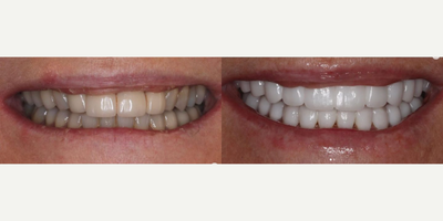 55-64 year old woman treated with Porcelain Veneers, Smile Makeover - Full mouth rehabilitation. This 60-year-old female patient presented with multiple old bridges, many missing upper teeth, over-prepped teeth, and decay. Aesthetically she wanted a much cleaner brighter and youthful look. This was a combination of 24 porcelain restorations including crowns veneers and bridges. She required gum procedures (crown lengthening) as well, especially the front lateral. This was for stability, not aesthetics, and not in her smile line (her lip covers it when she smiles) The purpose of this was health function and aestheticsand she looks a decade younger.