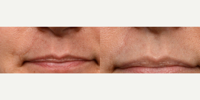 35-44 year old woman treated with eMatrix - Scar removal with Nurse Practitioner Radhika: A combination of treatments was used, including eMatrix, CO2 laser, and PRP with subcision.