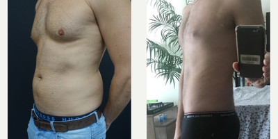 25-34 year old man treated with Gynecomastia Surgery - Gynecomastia + Vaser Full Waist Lipo - 1 Month Post Operative
