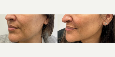 Woman treated with Microneedling, VI Peel, SkinPen - Woman treated with Microneedling, VI Peel, SkinPen