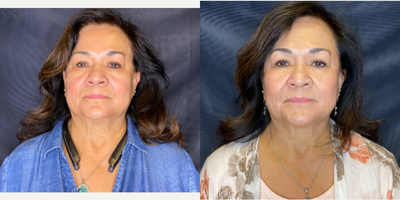 65-74 year old woman treated with Skin Tightening - Skin tightening used was In Mode Evoke Cheeks. Evoke is is the industrys first hands-free applicator designed specifically to address cheeks and jowls or the chin. The patented technology harnesses the power of RF energy to remodel facial tissue and improve its appearance. It is completely painless and has zero downtime. As you can see, it appears she has lost weight and that the tissue has tightened. Tissue remodeling is referring to the ability to reduce the fat content and restore collagen.