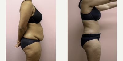 35-44 year old woman treated with Tummy Tuck - This lovely young mother has been struggling with excess abdominal fullness which has failed diet and exercise intervention. She underwent an abdominoplasty with liposuction of the flanks and is shown 2 months post-op. She is loving her results!