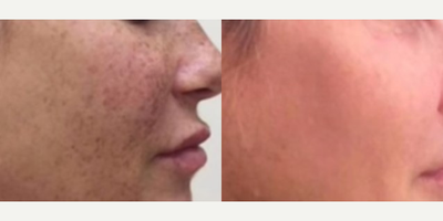 Woman treated with Lumecca - Woman treated with Lumecca