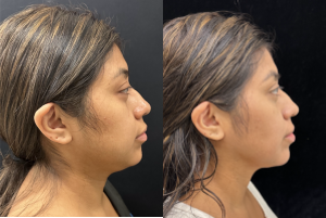 32 year old woman treated with Chin Liposuction - 32 year old woman treated with Chin Liposuction