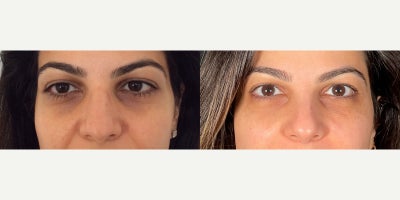 35-44 year old woman treated with Dermal Fillers - Non Surgical Blepharoplasty is an alternative to surgical blepharoplasty. Using careful, and precise injections of dermal filler the under eyes can be refreshed and restored. Dermal fillers, made of hyaluronic acid, can fill in depressions and reduce the appearance of dark circles and bags.