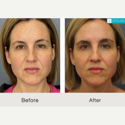 35-44 year old woman treated with IPL - A real patient after treatment with the BBL Hero IPL device.