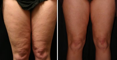 Accoustic Wave Therapy to front of legs - 
	Image courtesy of Medsurge Advances, Procedure performed by Dr. Bill Johnson
