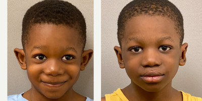 6 year old boy treated with Ear Surgery - 6 year old s/p otoplasty performed under straight local anesthesia performed in our on site AAAA certified operating suite