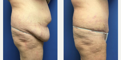 45-54 year old woman treated with Tummy Tuck - 47 year old female had lost 70 pounds with a gastric sleeve wanted a smother abdominal contour and had a tummy tuck with liposuction