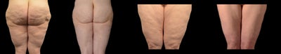 18-24 year old woman treated with Liposuction - Hi definition water assisted (BodyJet) and ultrasound assisted (VASER) contouring of the legs including the inner and outer thighs for lipedema, a genetic condition of disproportionate fat cells with associated pain and swelling.