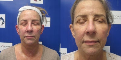 65-74 year old woman treated with Microneedling RF - Before and after 3 Sylfirm X RF microneedling treatments. History of rosacea , hyperpigmentation and scarring. Sessions over 3 months. Topical exosomes were also used. JB