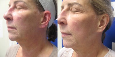 65-74 year old woman treated with Microneedling RF - Before and after 3 Sylfirm X RF microneedling treatments. History of rosacea , hyperpigmentation and scarring. Sessions over 3 months. Topical exosomes were also used. JB